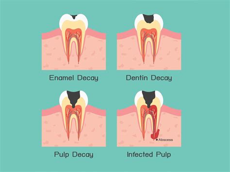 How to Save a Damaged Tooth With No Root Canal 